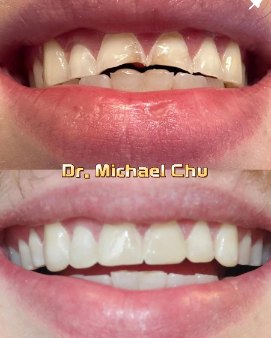 Composite bonding in 60 minutes