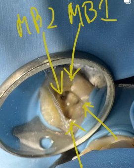 Finding the hidden MB2 canal – Dr Michael Chu