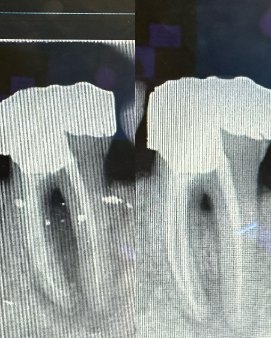 Root canal – 1 year review