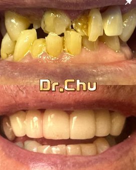 Full smile restoration