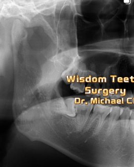 Impacted lower wisdom tooth