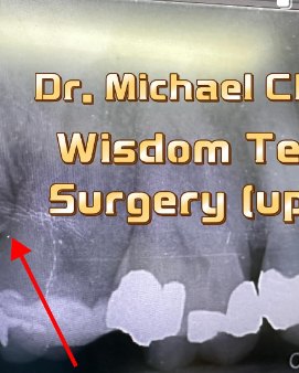 Upper wisdom tooth surgery